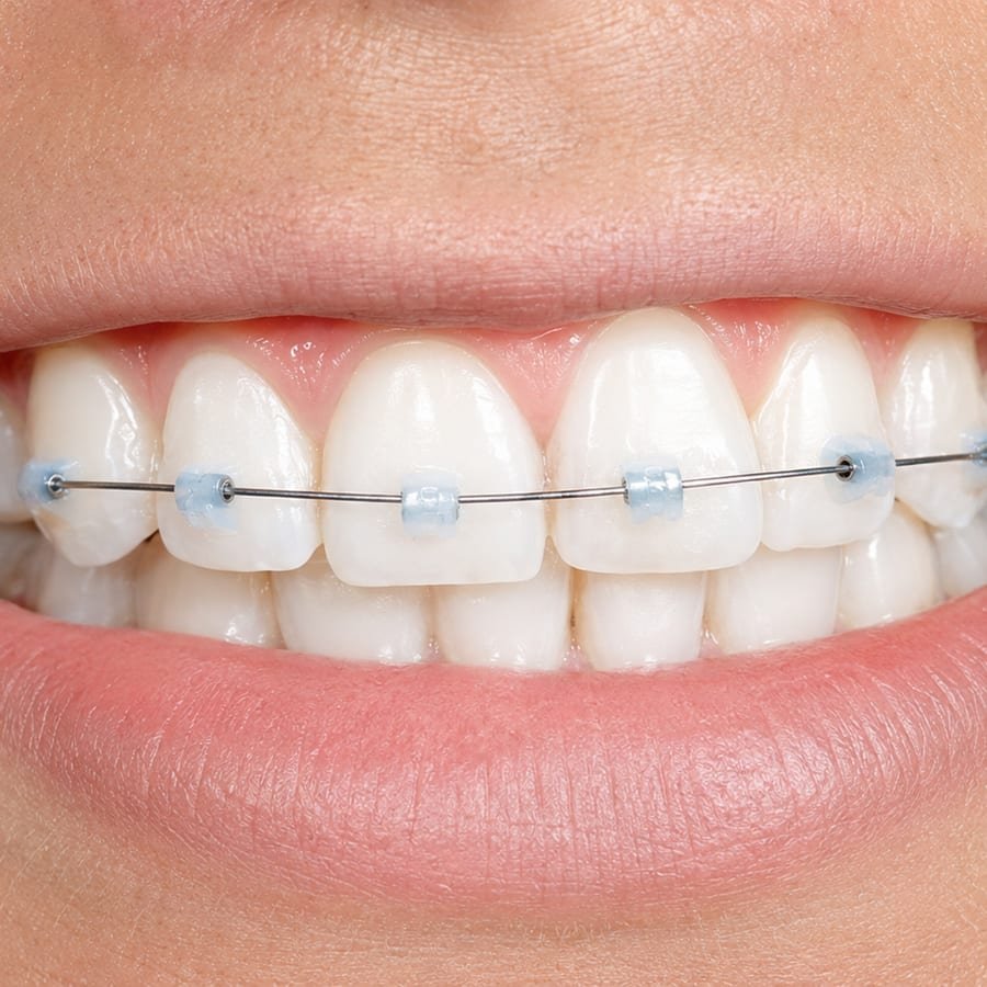 Ortodoncia con brackets