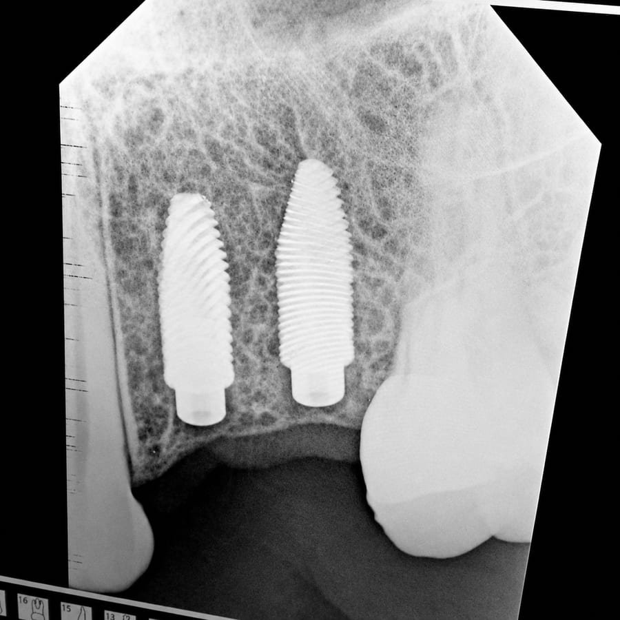 Implantes dentales colocados