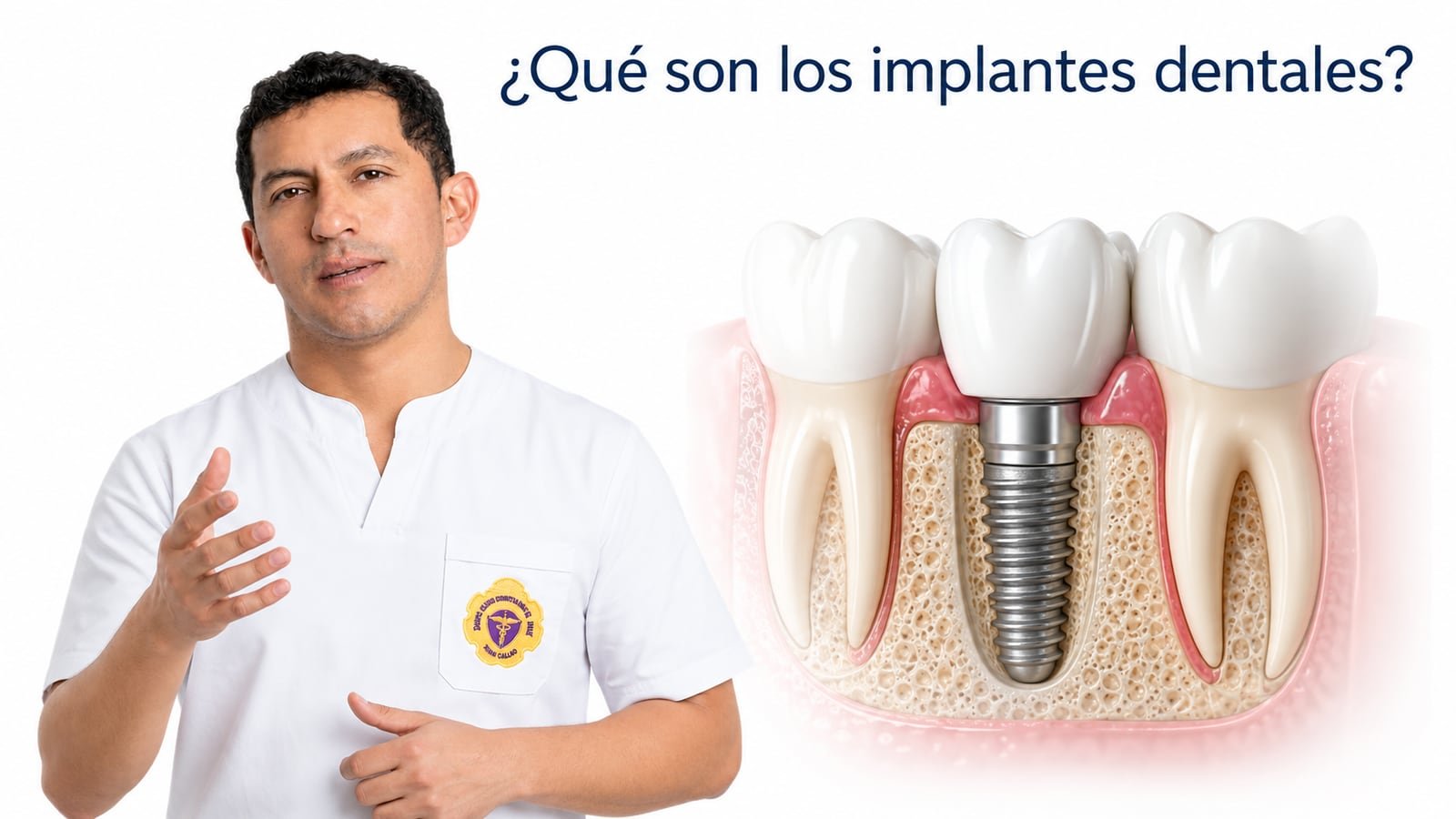 Implante dental colocado en el maxilar
